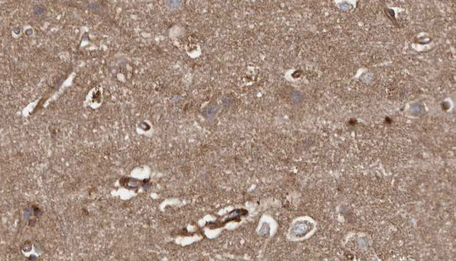 HACE1 Antibody - 1:100 staining human brain carcinoma tissue by IHC-P. The sample was formaldehyde fixed and a heat mediated antigen retrieval step in citrate buffer was performed. The sample was then blocked and incubated with the antibody for 1.5 hours at 22°C. An HRP conjugated goat anti-rabbit antibody was used as the secondary.