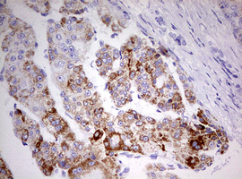 HADH Antibody - IHC of paraffin-embedded Carcinoma of Human liver tissue using anti-HADH mouse monoclonal antibody. (Heat-induced epitope retrieval by 10mM citric buffer, pH6.0, 120°C for 3min).