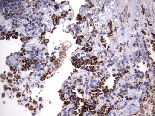 HADH Antibody - Immunohistochemical staining of paraffin-embedded Carcinoma of Human lung tissue using anti-HADH mouse monoclonal antibody.  heat-induced epitope retrieval by 10mM citric buffer, pH6.0, 120C for 3min)
