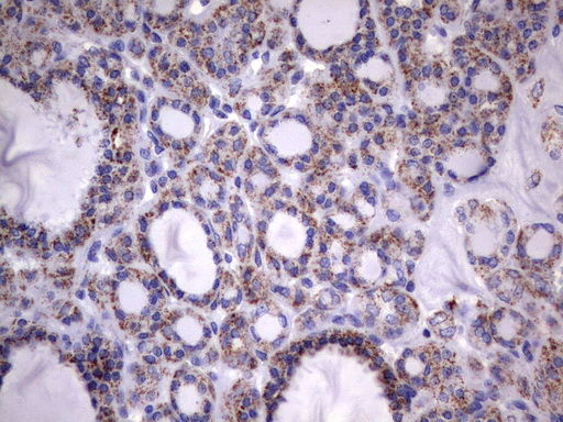 HADH Antibody - Immunohistochemical staining of paraffin-embedded Carcinoma of Human thyroid tissue using anti-HADH mouse monoclonal antibody.  heat-induced epitope retrieval by 10mM citric buffer, pH6.0, 120C for 3min)