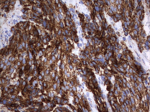 HADH Antibody - Immunohistochemical staining of paraffin-embedded Adenocarcinoma of Human breast tissue using anti-HADH mouse monoclonal antibody.  heat-induced epitope retrieval by 10mM citric buffer, pH6.0, 120C for 3min)