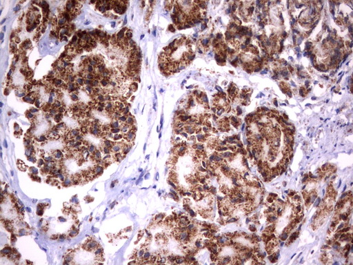 HADH Antibody - Immunohistochemical staining of paraffin-embedded Carcinoma of Human prostate tissue using anti-HADH mouse monoclonal antibody.  heat-induced epitope retrieval by 10mM citric buffer, pH6.0, 120C for 3min)