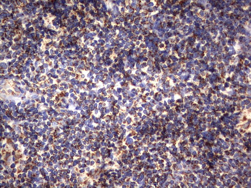 HADH Antibody - Immunohistochemical staining of paraffin-embedded Human lymphoma tissue using anti-HADH mouse monoclonal antibody.  heat-induced epitope retrieval by 10mM citric buffer, pH6.0, 120C for 3min)