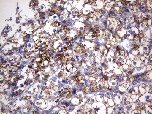 HADH Antibody - Immunohistochemical staining of paraffin-embedded Carcinoma of Human kidney tissue using anti-HADH mouse monoclonal antibody.  heat-induced epitope retrieval by 10mM citric buffer, pH6.0, 120C for 3min)