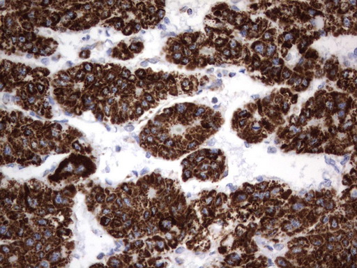 HADH Antibody - Immunohistochemical staining of paraffin-embedded Carcinoma of Human liver tissue using anti-HADH mouse monoclonal antibody.  heat-induced epitope retrieval by 10mM citric buffer, pH6.0, 120C for 3min)