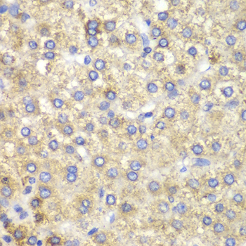 HADH Antibody - Immunohistochemistry of paraffin-embedded human liver cancer using HADH antibodyat dilution of 1:100 (40x lens).