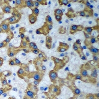 HADHA Antibody - Immunohistochemical analysis of HADHA staining in human liver cancer formalin fixed paraffin embedded tissue section. The section was pre-treated using heat mediated antigen retrieval with sodium citrate buffer (pH 6.0). The section was then incubated with the antibody at room temperature and detected using an HRP conjugated compact polymer system. DAB was used as the chromogen. The section was then counterstained with hematoxylin and mounted with DPX.