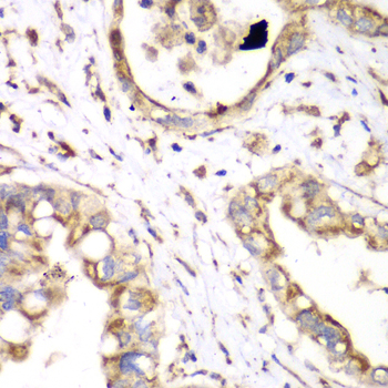 HADHA Antibody - Immunohistochemistry of paraffin-embedded human liver cancer using HADHA antibody at dilution of 1:100 (40x lens).