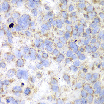 HADHA Antibody - Immunohistochemistry of paraffin-embedded human esophageal cancer using HADHA antibody at dilution of 1:100 (40x lens).