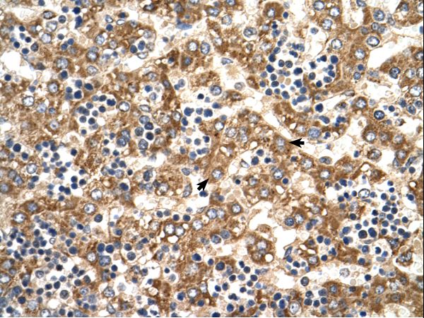 HADHB Antibody - Paraffin embedded tissue: Human Liver. Cells with positive label: Hepatocytes (indicated with arrows). Antibody concentration: 4-8 ug/ml. Magnification: 400X.  This image was taken for the unconjugated form of this product. Other forms have not been tested.