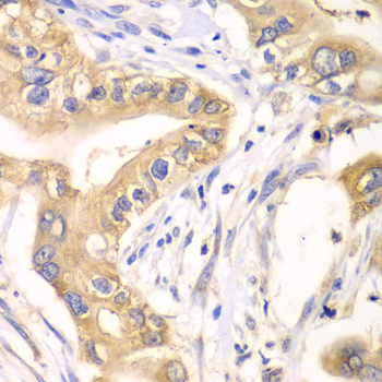 HAGH Antibody - Immunohistochemistry of paraffin-embedded human liver cancer tissue.