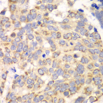 HAGH Antibody - Immunohistochemistry of paraffin-embedded human esophageal cancer tissue.