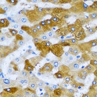 HAGH Antibody - Immunohistochemical analysis of HAGH staining in human liver cancer formalin fixed paraffin embedded tissue section. The section was pre-treated using heat mediated antigen retrieval with sodium citrate buffer (pH 6.0). The section was then incubated with the antibody at room temperature and detected using an HRP conjugated compact polymer system. DAB was used as the chromogen. The section was then counterstained with hematoxylin and mounted with DPX.