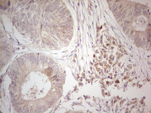 Hairless / HR Antibody - Immunohistochemical staining of paraffin-embedded Adenocarcinoma of Human colon tissue using anti-HR mouse monoclonal antibody. (Heat-induced epitope retrieval by Tris-EDTA, pH8.0) Dilution: 1:150