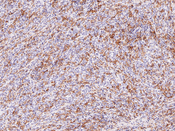 Hairy Cell Leukemia Antibody - Hairy Cell Leukemia on Lymphoma