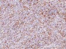 Hairy Cell Leukemia Antibody - Hairy Cell Leukemia on Lymphoma