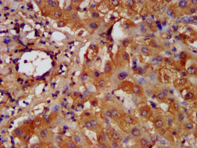 HAL / Histidine Ammonium Lyase Antibody - Immunohistochemistry image at a dilution of 1:200 and staining in paraffin-embedded human liver tissue performed on a Leica BondTM system. After dewaxing and hydration, antigen retrieval was mediated by high pressure in a citrate buffer (pH 6.0) . Section was blocked with 10% normal goat serum 30min at RT. Then primary antibody (1% BSA) was incubated at 4 °C overnight. The primary is detected by a biotinylated secondary antibody and visualized using an HRP conjugated SP system.