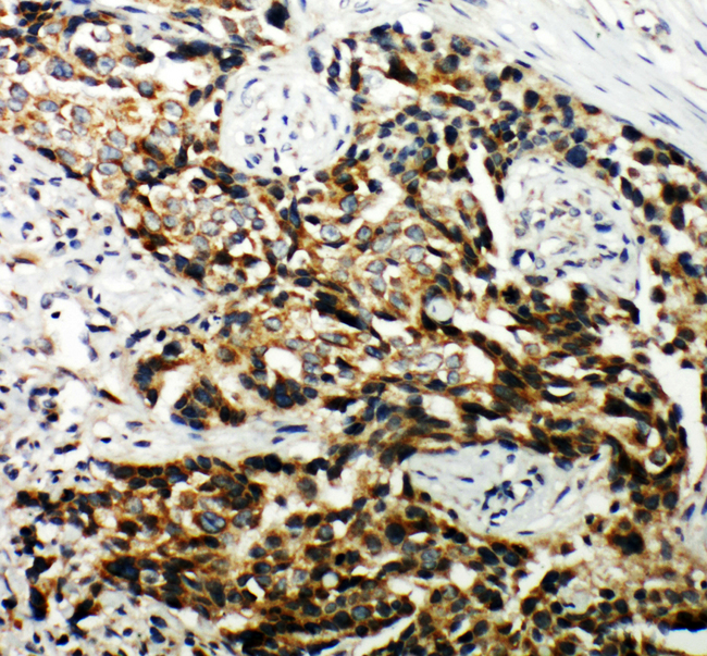 Hamartin / TSC1 Antibody - Hamartin / TSC1 antibody. IHC(P): Human Breast Cancer Tissue.