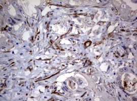 Hamartin / TSC1 Antibody - IHC of paraffin-embedded Adenocarcinoma of Human colon tissue using anti-TSC1 mouse monoclonal antibody.