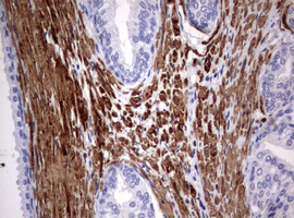 Hamartin / TSC1 Antibody - IHC of paraffin-embedded Carcinoma of Human prostate tissue using anti-TSC1 mouse monoclonal antibody.