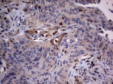 Hamartin / TSC1 Antibody - IHC of paraffin-embedded Carcinoma of Human lung tissue using anti-TSC1 mouse monoclonal antibody.