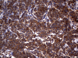 Hamartin / TSC1 Antibody - IHC of paraffin-embedded Human lymphoma tissue using anti-TSC1 mouse monoclonal antibody.