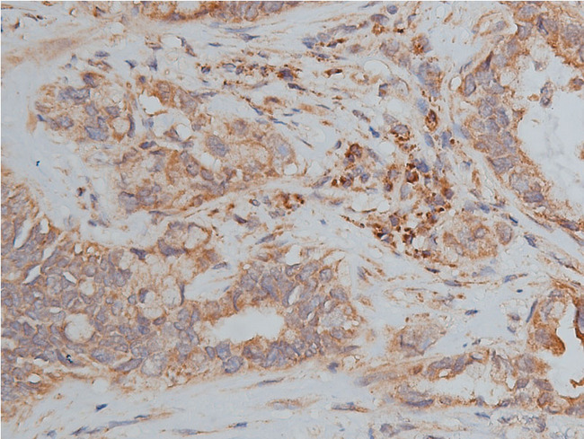 Hamartin / TSC1 Antibody - 1:50 staining human lung carcinoma tissue by IHC-P. The tissue was formaldehyde fixed and a heat mediated antigen retrieval step in citrate buffer was performed. The tissue was then blocked and incubated with the antibody for 1.5 hours at 22°C. An HRP conjugated goat anti-rabbit antibody was used as the secondary.