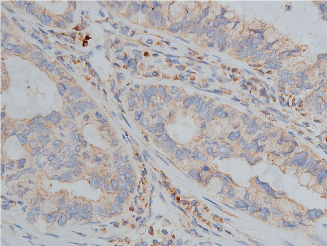 Hamartin / TSC1 Antibody - 1:200 staining human lung carcinoma tissue by IHC-P. The tissue was formaldehyde fixed and a heat mediated antigen retrieval step in citrate buffer was performed. The tissue was then blocked and incubated with the antibody for 1.5 hours at 22°C. An HRP conjugated goat anti-rabbit antibody was used as the secondary.