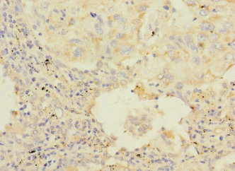 HAND1 Antibody - Immunohistochemistry of paraffin-embedded human lung cancer at dilution 1:100