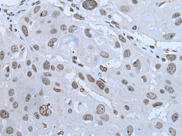 HAND1 Antibody - Immunohistochemistry of paraffin-embedded Human esophagus cancer tissue  using HAND1 Polyclonal Antibody at dilution of 1:30(×200)