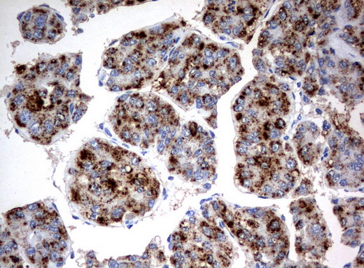 HAO1 Antibody - Immunohistochemical staining of paraffin-embedded Carcinoma of Human liver tissue using anti-HAO1mouse monoclonal antibody.  heat-induced epitope retrieval by 10mM citric buffer, pH6.0, 120C for 3min)