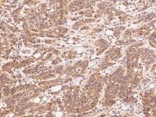HAO1 Antibody - Immunochemical staining of human HAO-1 in human pancreatic carcinoma with rabbit polyclonal antibody at 1:2500 dilution, formalin-fixed paraffin embedded sections.