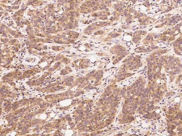 HAO1 Antibody - Immunochemical staining of human HAO-1 in human pancreatic carcinoma with rabbit polyclonal antibody at 1:2500 dilution, formalin-fixed paraffin embedded sections.