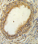 HAPLN1 Antibody - HAPLN1 Antibody IHC of formalin-fixed and paraffin-embedded prostate carcinoma followed by peroxidase-conjugated secondary antibody and DAB staining. This data demonstrates the use of the HAPLN1 Antibody for immunohistochemistry.