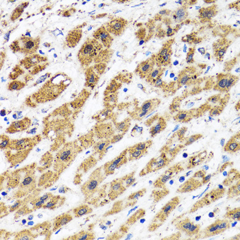 HAPLN1 Antibody - Immunohistochemistry of paraffin-embedded human liver cancer tissue.