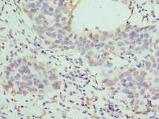 HAPLN1 Antibody - Immunohistochemistry of paraffin-embedded human bladder cancer at dilution 1:100
