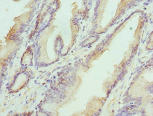 HAPLN1 Antibody - Immunohistochemistry of paraffin-embedded human prostata cancer at dilution 1:100