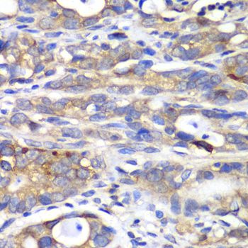 HAPLN1 Antibody - Immunohistochemistry of paraffin-embedded human gastric cancer using HAPLN1 antibody at dilution of 1:100 (40x lens).