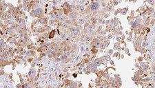 HAPLN1 Antibody - 1:100 staining human Melanoma tissue by IHC-P. The sample was formaldehyde fixed and a heat mediated antigen retrieval step in citrate buffer was performed. The sample was then blocked and incubated with the antibody for 1.5 hours at 22°C. An HRP conjugated goat anti-rabbit antibody was used as the secondary.