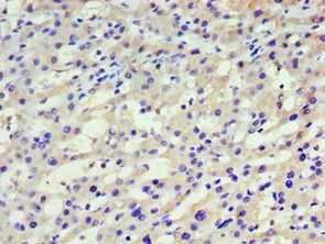 HARS Antibody - Immunohistochemistry of paraffin-embedded human liver cancer using antibody at 1:100 dilution.