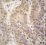 HARS Antibody - Formalin-fixed and paraffin-embedded human hepatocarcinoma tissue reacted with HARS antibody , which was peroxidase-conjugated to the secondary antibody, followed by DAB staining. This data demonstrates the use of this antibody for immunohistochemistry; clinical relevance has not been evaluated.
