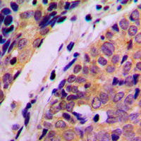 HARS Antibody - Immunohistochemical analysis of HARS staining in human breast cancer formalin fixed paraffin embedded tissue section. The section was pre-treated using heat mediated antigen retrieval with sodium citrate buffer (pH 6.0). The section was then incubated with the antibody at room temperature and detected using an HRP conjugated compact polymer system. DAB was used as the chromogen. The section was then counterstained with hematoxylin and mounted with DPX.