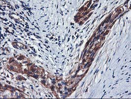 HARS2 Antibody - IHC of paraffin-embedded Carcinoma of Human bladder tissue using anti-HARS2 mouse monoclonal antibody.