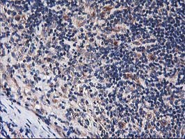 HARS2 Antibody - IHC of paraffin-embedded Human lymphoma tissue using anti-HARS2 mouse monoclonal antibody.