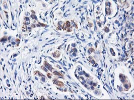 HARS2 Antibody - IHC of paraffin-embedded Carcinoma of Human lung tissue using anti-HARS2 mouse monoclonal antibody.
