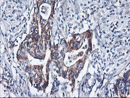 HARS2 Antibody - IHC of paraffin-embedded Carcinoma of Human pancreas tissue using anti-HARS2 mouse monoclonal antibody.
