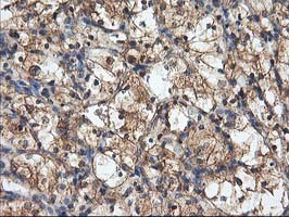 HARS2 Antibody - IHC of paraffin-embedded Carcinoma of Human kidney tissue using anti-HARS2 mouse monoclonal antibody.