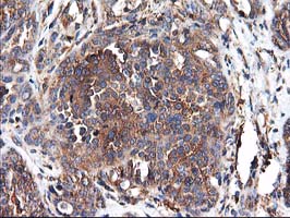 HARS2 Antibody - IHC of paraffin-embedded Adenocarcinoma of Human ovary tissue using anti-HARS2 mouse monoclonal antibody.