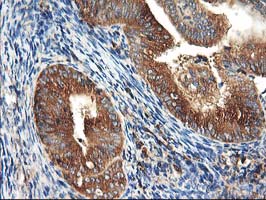 HARS2 Antibody - IHC of paraffin-embedded Adenocarcinoma of Human endometrium tissue using anti-HARS2 mouse monoclonal antibody.