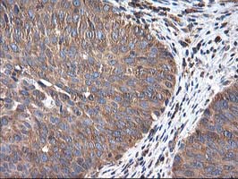 HARS2 Antibody - IHC of paraffin-embedded Carcinoma of Human bladder tissue using anti-HARS2 mouse monoclonal antibody.